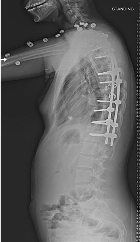 Adolescent Idiopathic Scoliosis Treatment