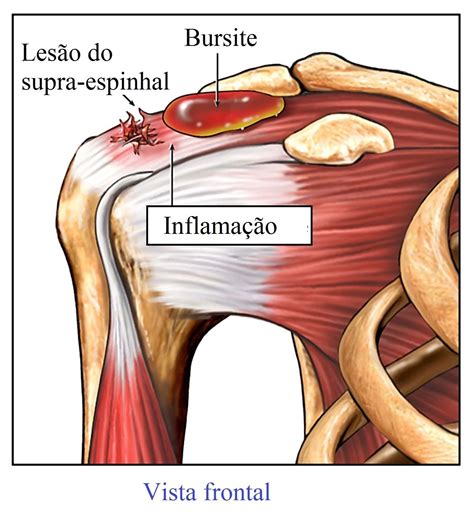 Bursite Subacromial Ombro Dor No Ombro Bursite Anatomia Ombro