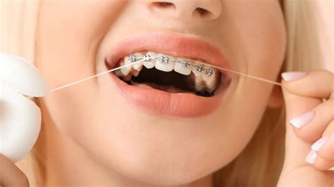 What To Expect During Your Braces Journey A Step By Step Guide To