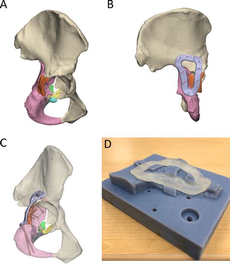 Case Right Hemipelvis Plate And Clamping Fixture Design A The