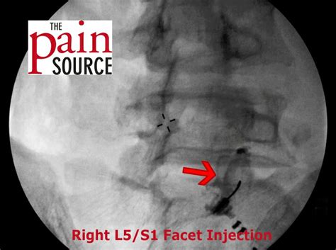 VIDEOS: Lumbar Facet Injections under Fluoroscopy - The Pain Source ...