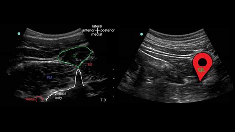 Quadratus Lumborum Block