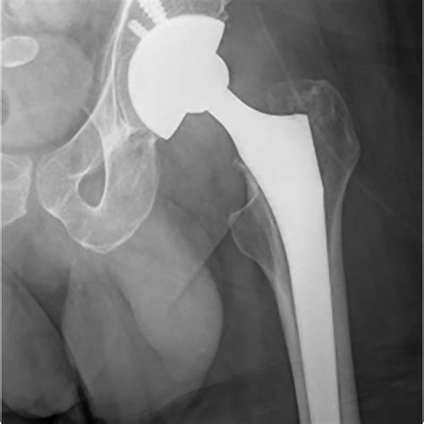 Nondisplaced Intertrochanteric Right Fracture Subsequent To A