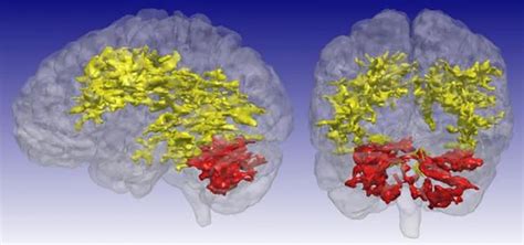 Bipolar Disorder Iowa Neuroscience Institute