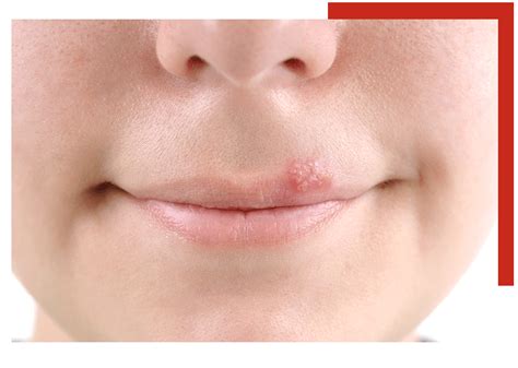 Herpes Simplex Virus Sutton Dermatology Aesthetics Ctr