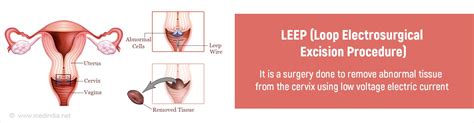 Leep Loop Electrosurgical Excision Procedure Indications Preparation Procedure Recovery