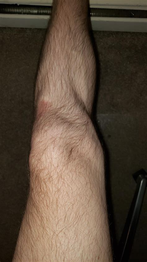 Lump on medial side, feels swollen stiff especially after walking. Only