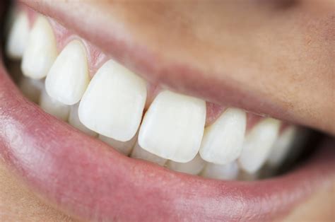 Overbite Malocclusion