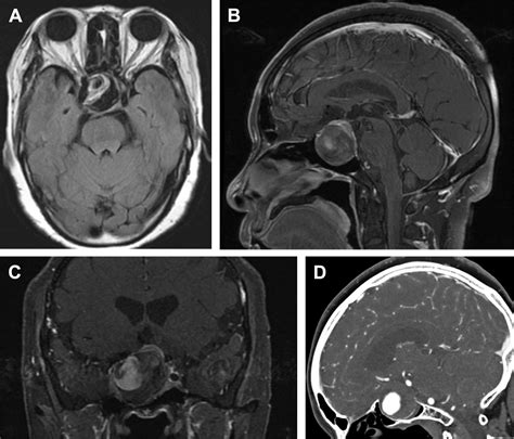 Imaging Of The Sella And Parasellar Region Radiologic Clinics