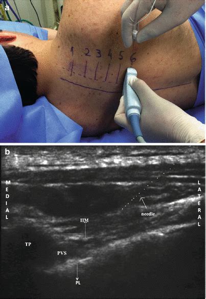 Intercostal Nerve Entrapment Abdomen SpringerLink