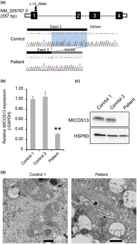 A Novel Homozygous Variant In MICOS13 QIL1 Causes Hepatoencephalopathy