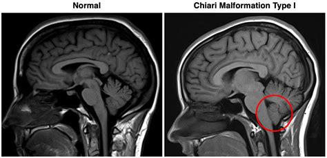 Under Pressure The Diary Of A Chiari Malformation Lions Talk Science