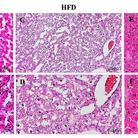 Histological Evaluation Of Hepatic Steatosis Differences In Hepatic