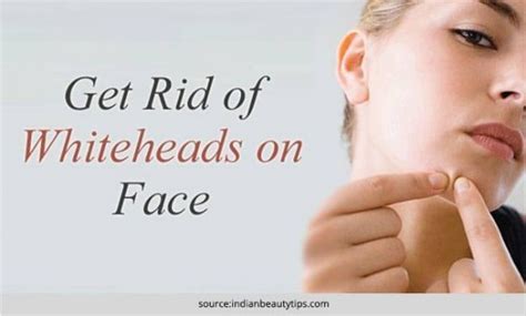 How To Get Rid Of Whiteheads Home Remedies