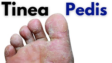 Tinea Pedis Symptoms And Treatment Toe Fungus Infection Athletes