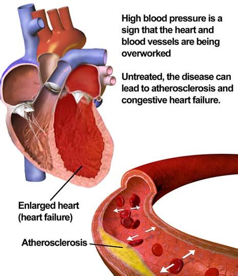 Hypertension Is So Common That Almost Everyone Is Affected At Some