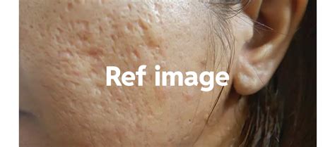 Pitted Acne Scars Before After