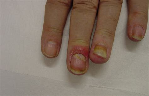 The Clinical Spectrum Of Psoriasis Clinics In Dermatology