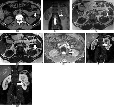 Cross Sectional Imaging Assessment Of Renal Masses With 46 OFF