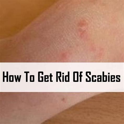 Scabies Rash On Stomach