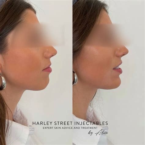 Harley Street Injectables On Instagram Before And After Chin Filler