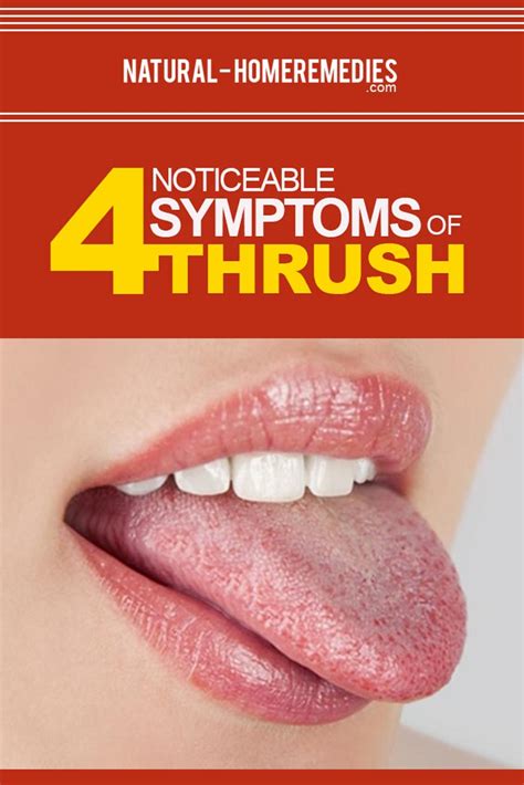 Various Noticeable Symptoms Of Thrush - Tips To Identify Symptoms Of ...