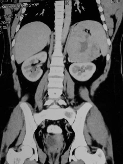 Ct Scan Showing Adrenal Mass Download Scientific Diagram