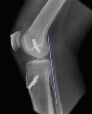 Villar Bajwa Practice - PCL Reconstruction (Posterior Cruciate Ligament)