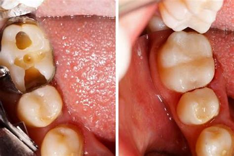 Obturaciones Dentales Estéticas Axioma Estudi Dental