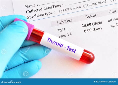 Lab Result of Hypothyroidism Stock Photo - Image of metabolism, gland ...