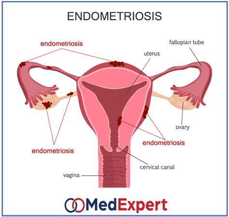 Endometriosis Symptoms And Endometriosis Treatment MED Expert