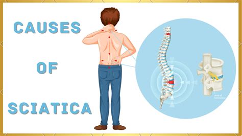 Causes of Sciatica - Medinutrica