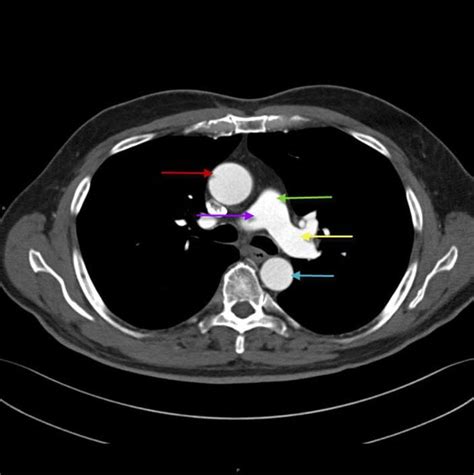 Image Tc De Tórax Mostrando A Anatomia Da Aorta E Artéria Pulmonar