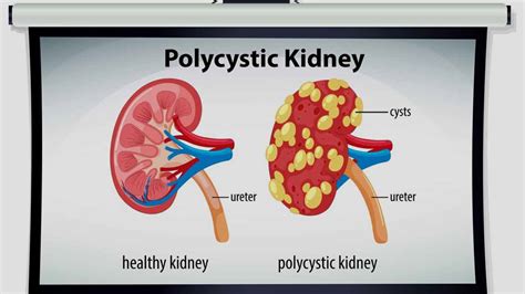 Polycystic Kidney Disease: Causes and Symptoms | OnlyMyHealth