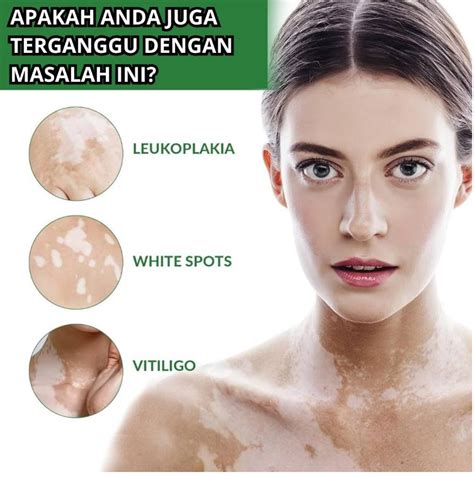 obat vitiligo obat penyakit kulit obat bercak putih  kulit obat