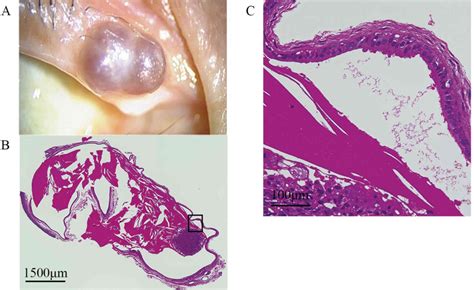 Clinicopathological Features Of Cystic Lesions In The Eyelid