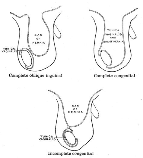 Inguinal Hernia Statpearls Ncbi Bookshelf