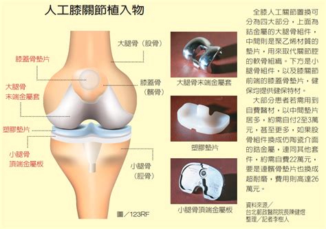 換膝關節必知！健保或自費 關鍵在塑膠墊片｜骨科．復健｜科別｜元氣網