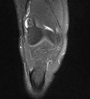 Osteochondroma Knee Joint Image Radiopaedia Org