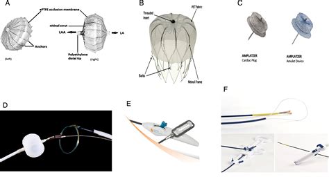 Left Atrial Appendage Occlusion For Stroke Prevention In Patients With