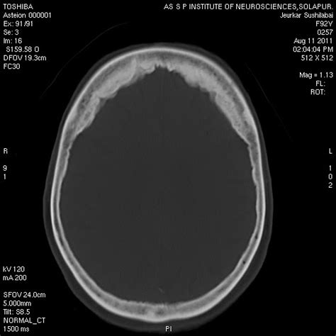 Dr Balaji Anvekar Frcr Hyperostosis Frontalis Interna