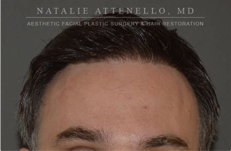 Beverly Hills Hair Restoration Before and After Photos - Los Angeles ...