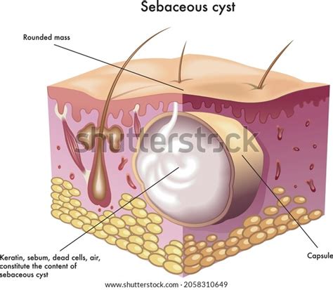 65件の「Subcutaneous cyst」の画像、写真素材、ベクター画像 | Shutterstock