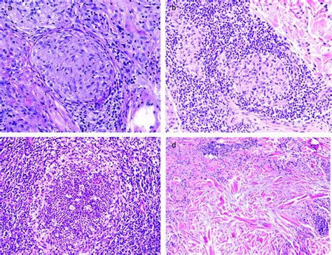 Histologic Features Of Granulomatous Skin Diseases Mitteldorf 2016 Jddg Journal Der