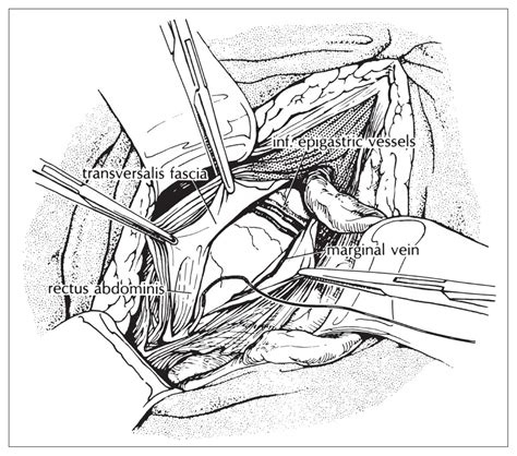 Inguinal Hernia Repair Shouldice