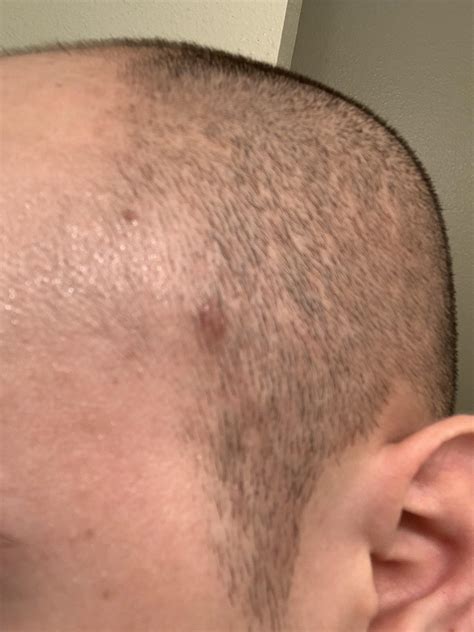 Moles On Head Scalp Hot Sex Picture