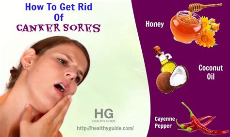 24 Tips How To Get Rid Of Canker Sores Inside The Mouth Fast And Naturally