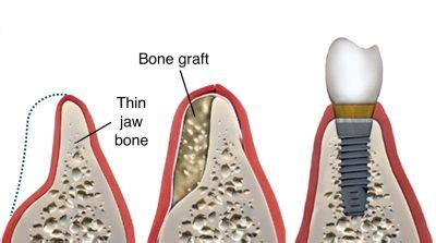 Bone-graft-dental-implant-2 - Pacific Oral Surgery