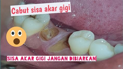 Cabut Sisa Akar Gigi Jangan Dibiarkan Bikin Infeksi Youtube