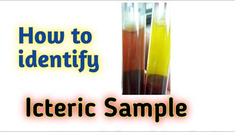 How to identify ictreic sample | icteric serum - YouTube